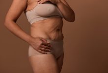 A verdade sobre a cicatriz da abdominoplastia