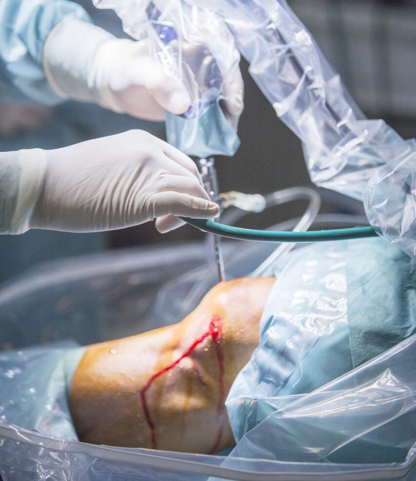 Sutura do menisco quando ela é indicada