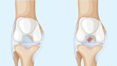 Lesão do LCA o problema que pode estar no seu joelho sem você saber