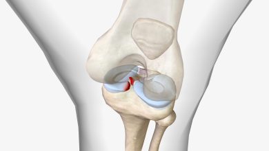 Lesionei o menisco É melhor reparar ou remover